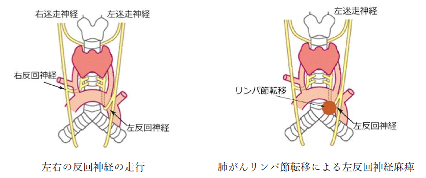 反回神経の走行の図